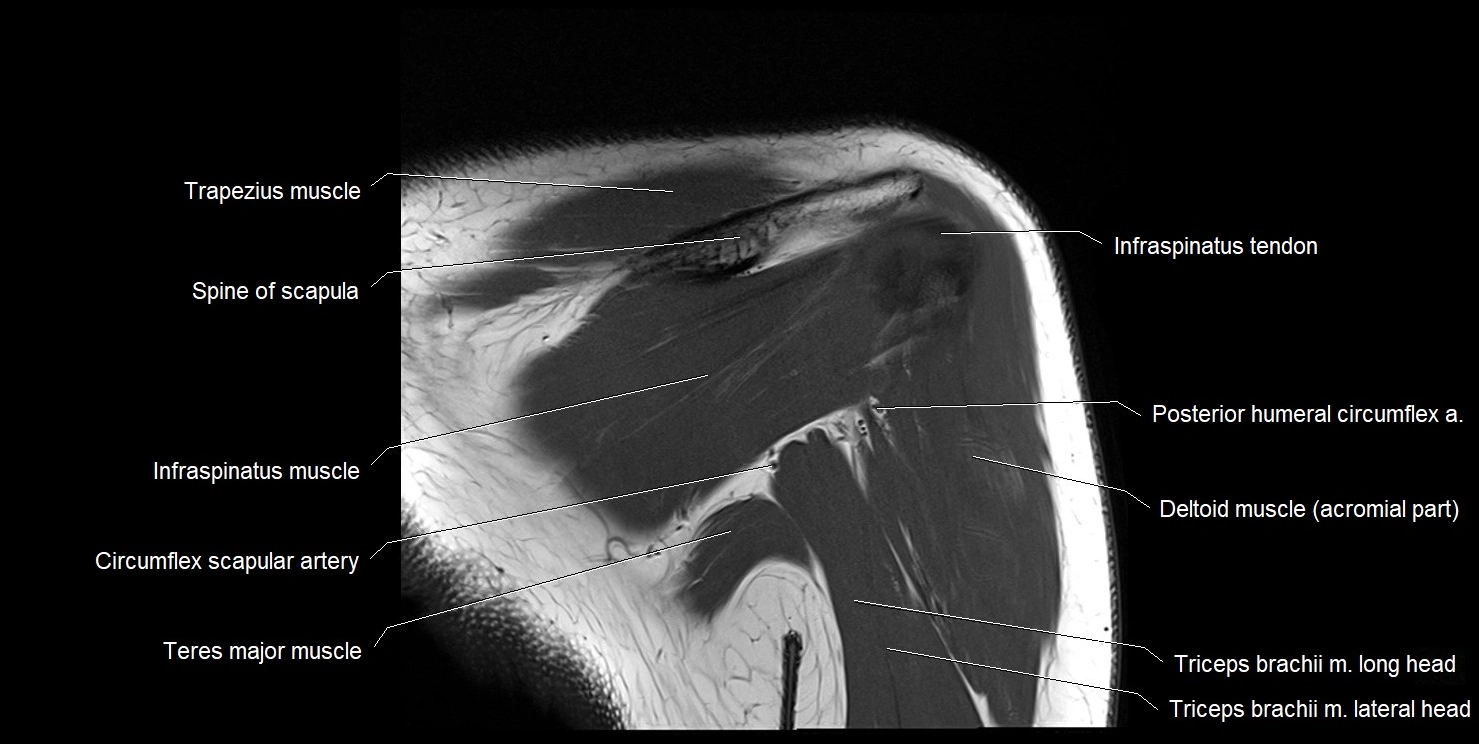 mri shoulder coronal cross sectional anatomy image 16.webp
